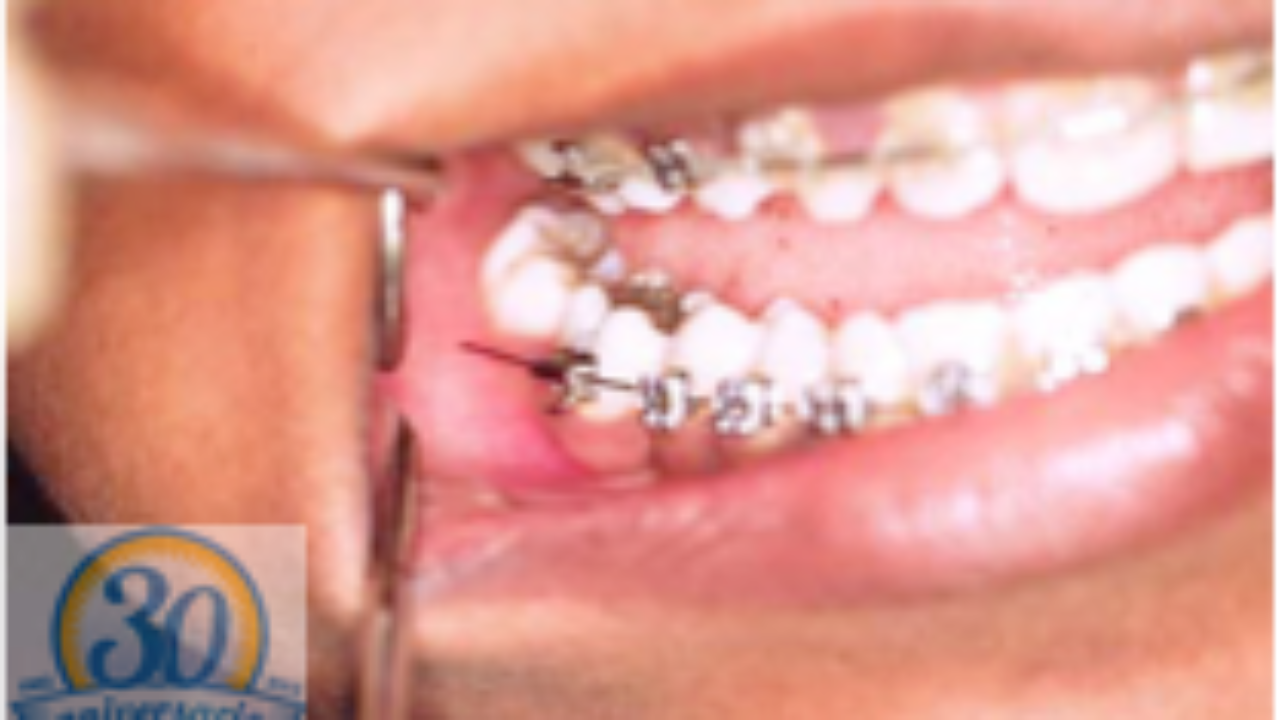 Brackets: Que Esperar Cuando Visitas Al Dentista