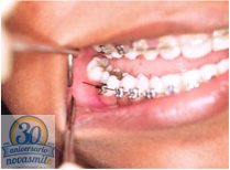 Incidencias en los tratamientos de ortodoncia