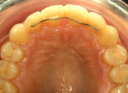 retenedor-fijo-ortodoncia-novasmile