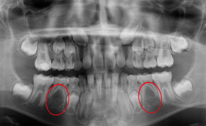 adultos con dientes de leche