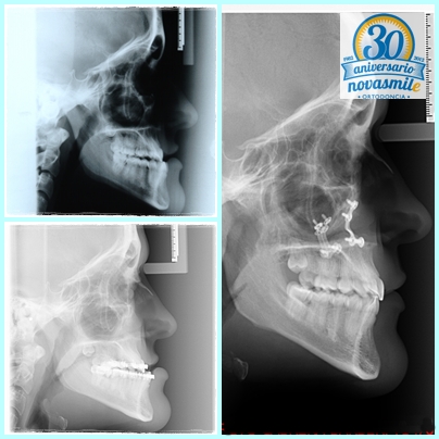 Ortodoncia y cirugía