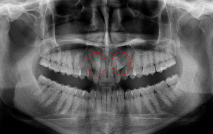 adultos con dientes de leche