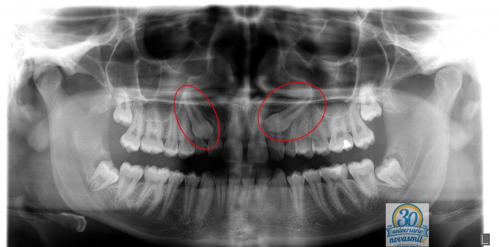 Dientes Incluidos