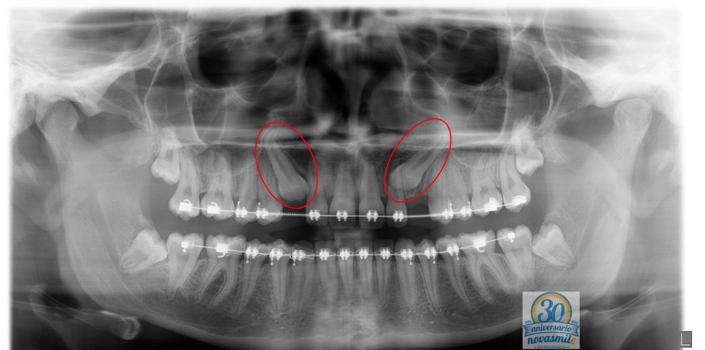 Dientes Incluidos