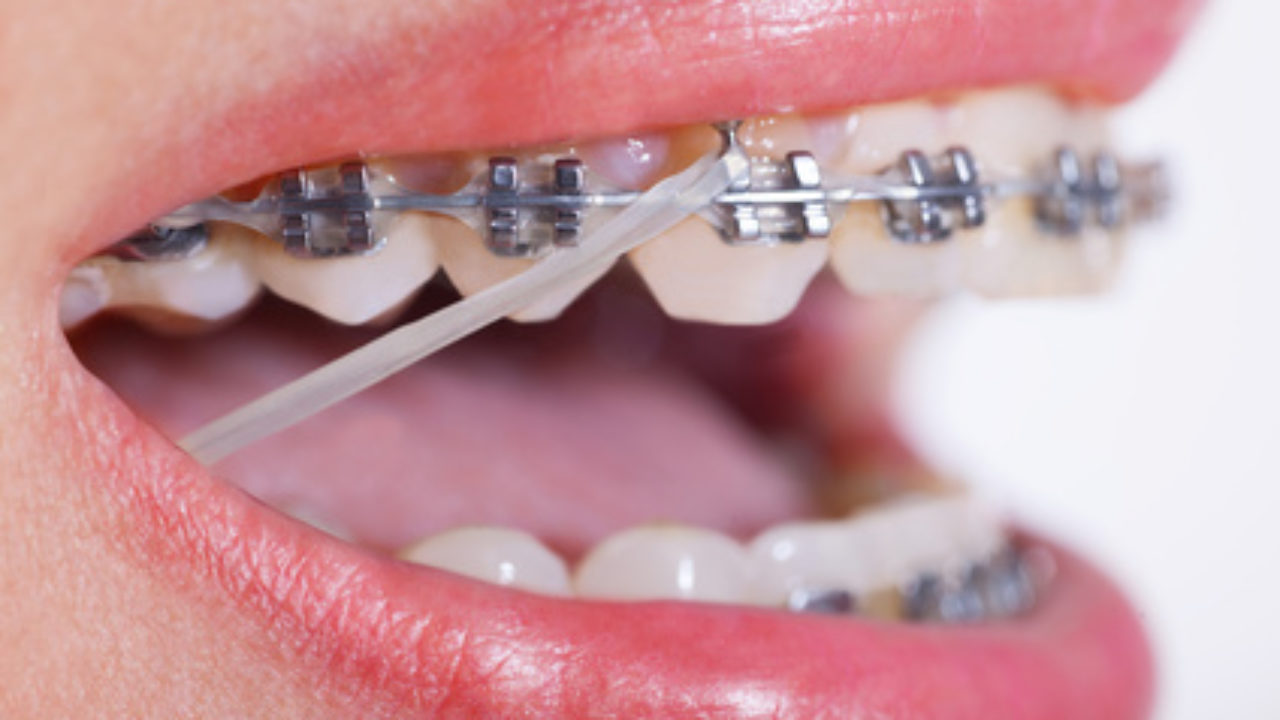 por de elásticos durante tratamiento de ortodoncia