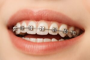 Cuidado de los dientes y encías durante el tratamiento de ortodoncia