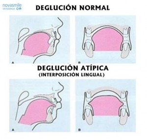 NORMAL VS ATIPICA