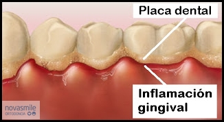 Eliminar la placa dental