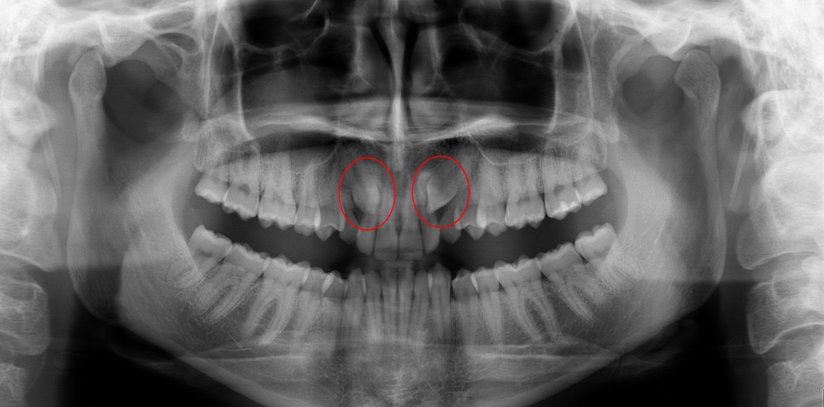¿Sabes qué es un diente "incluido"?