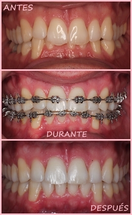 Brackets Autoligado - Antes y después