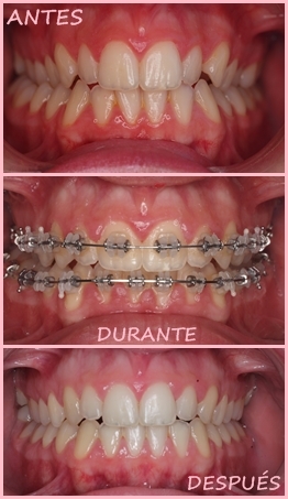 Brackets Autoligado - Antes y después