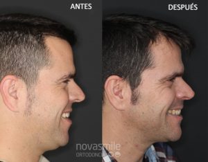 mejora perfil facial