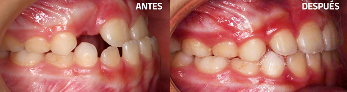 Mordida cruzada anterior y lateral - Ortodoncia antes y después
