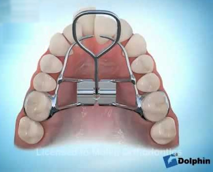Disyuntor en ortodoncia - Antes y después