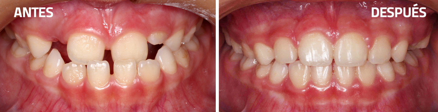 Dientes superiores en Tratamiento de Ortodoncia Antes y Después