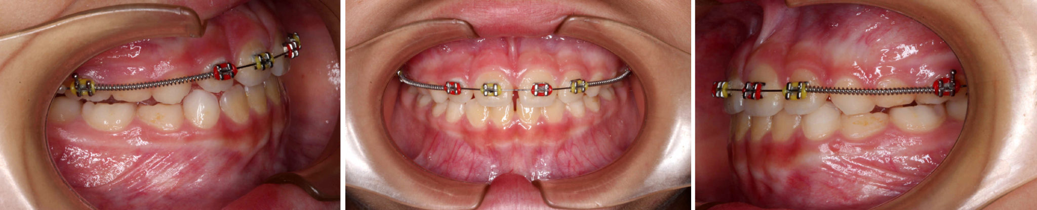 Tratamiento de Ortodoncia Antes y Después - Brackets Ortodoncia