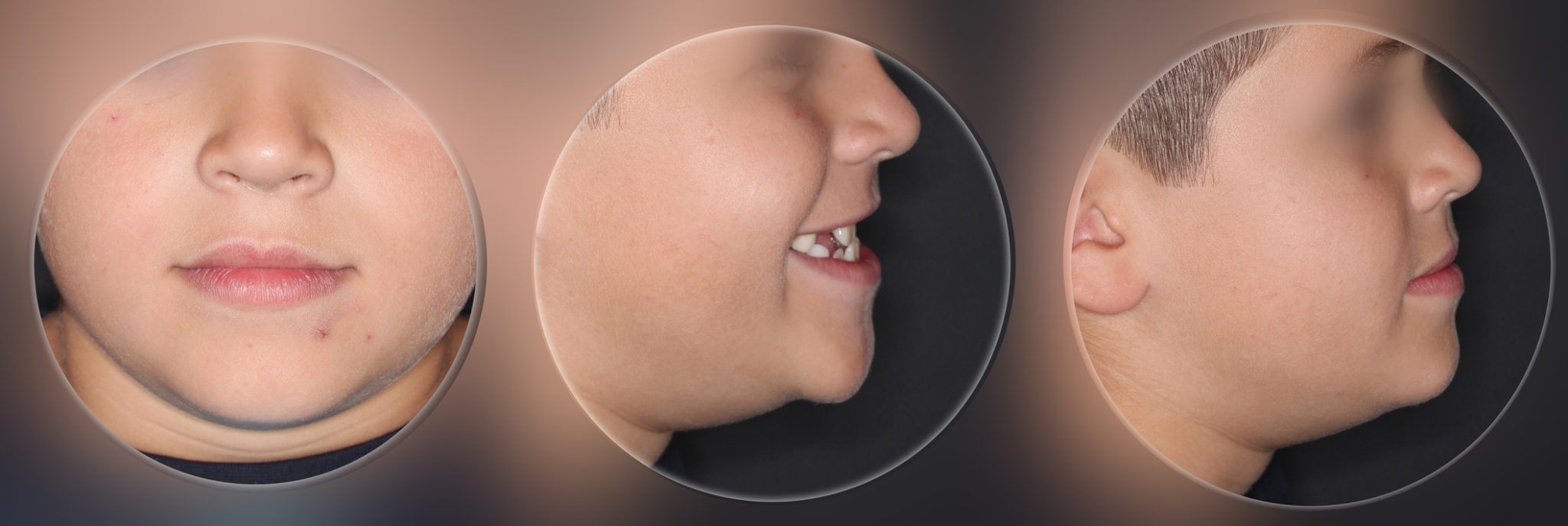 Primera fase de Tratamiento de Ortodoncia Infantil - Antes y Después