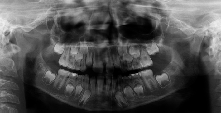 Ortopantomografía - Tratamiento de Ortodoncia Antes y Después