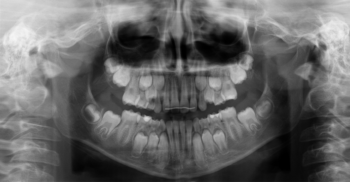 Ortopantomografía en Tratamiento Infantil de Ortodoncia Antes y Después
