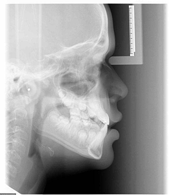 Radiografía - Tratamiento de Ortodoncia Antes y Después