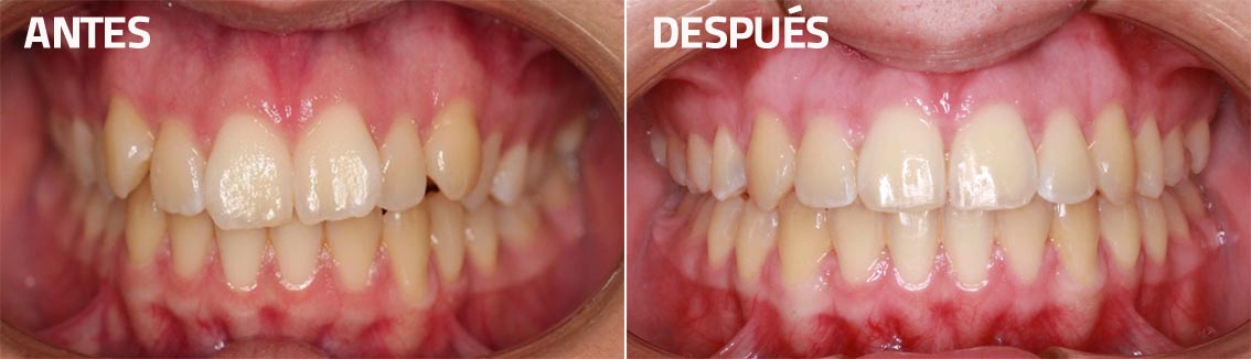 corrección-mordida-ortodoncia