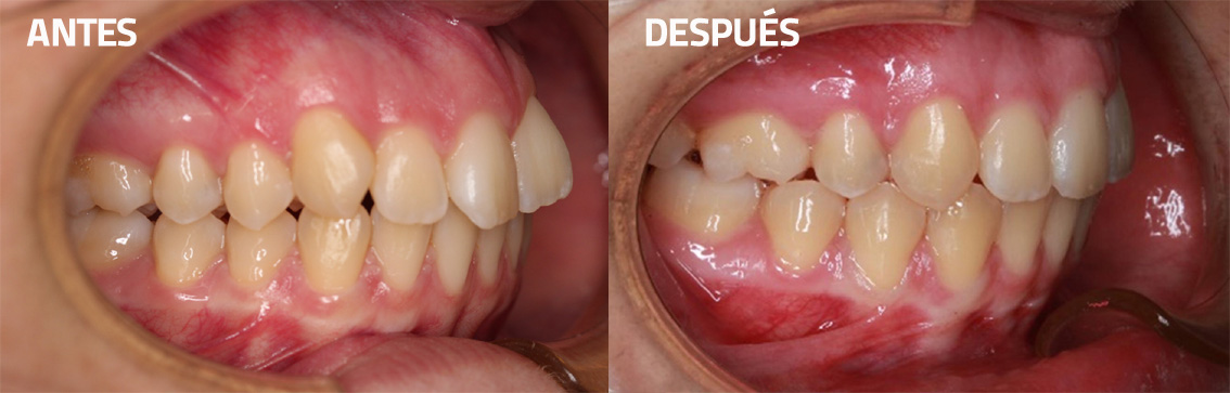 Corrección protrusión Novasmile