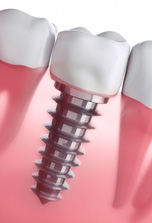 implante-ortodoncia
