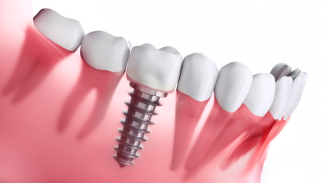 Tratamiento de ortodoncia con implantes, coronas o carillas