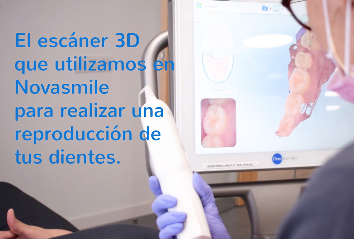 Conoce a iTero, el escáner 3D del tratamiento Invisalign. Novasmile