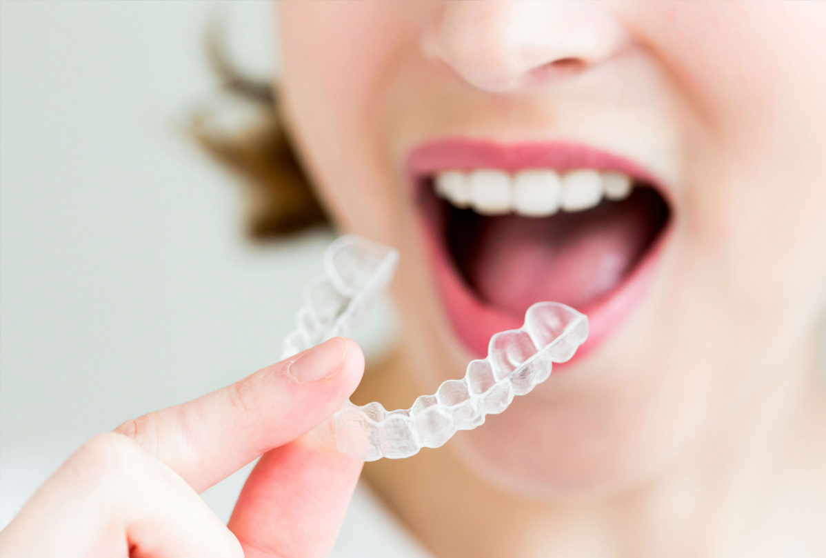 Mejorar tu sonrisa sin que nadie lo note ya es posible con Invisalign