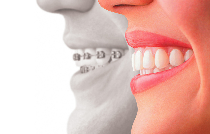 ¿Qué tipo de ortodoncia es la más indicada para mi? Novasmile. 