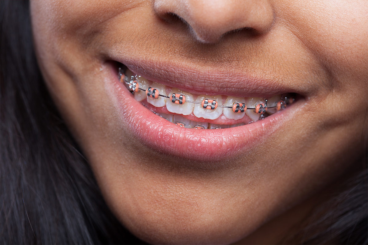 Consejos para solucionar problemas con tus brackets.