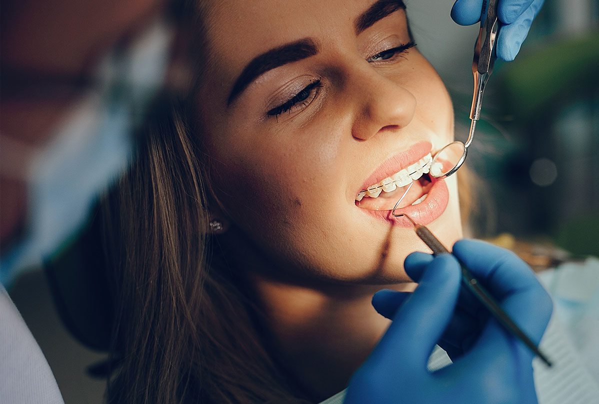 Tipos de brackets estéticos: cerámica, zafiro, zirconio y resina.