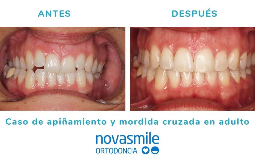 Antes y después de apiñamiento y mordida cruzada en adultos