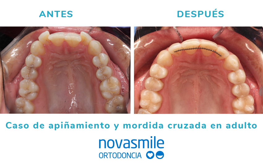 Antes y después de Apiñamiento y mordida cruzada en adultos