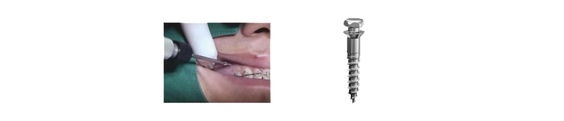 Ortodoncia preprotésica con ayuda de microtornillos