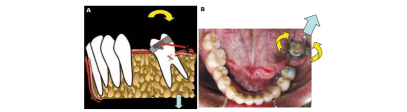 Ortodoncia preprotésica con ayuda de microtornillos