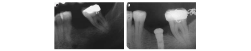 Radiografía - Ortodoncia preprotésica con ayuda de microtornillos