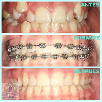 Antes, durante y después de extracciones dentales en ortodoncia.