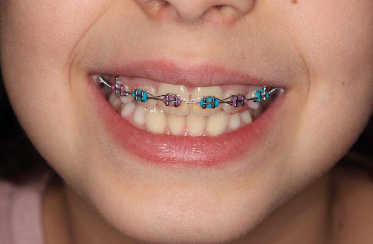 Brackets de Colores - Gomas para brackets con un toque de color