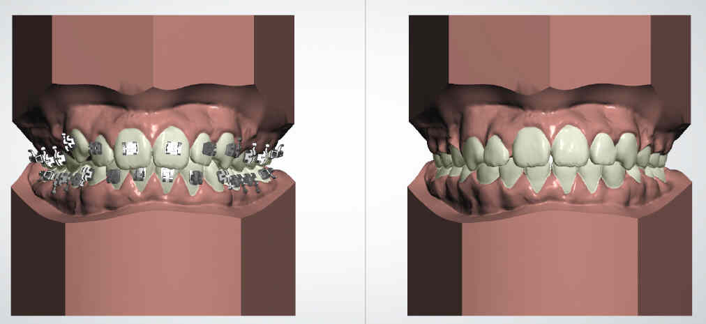 Brackets metálicos: precios y ventajas