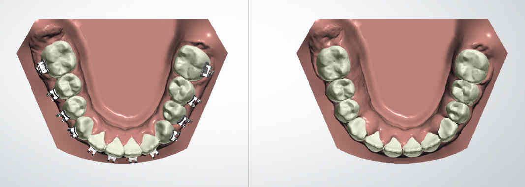 Brackets metálicos: precios y ventajas