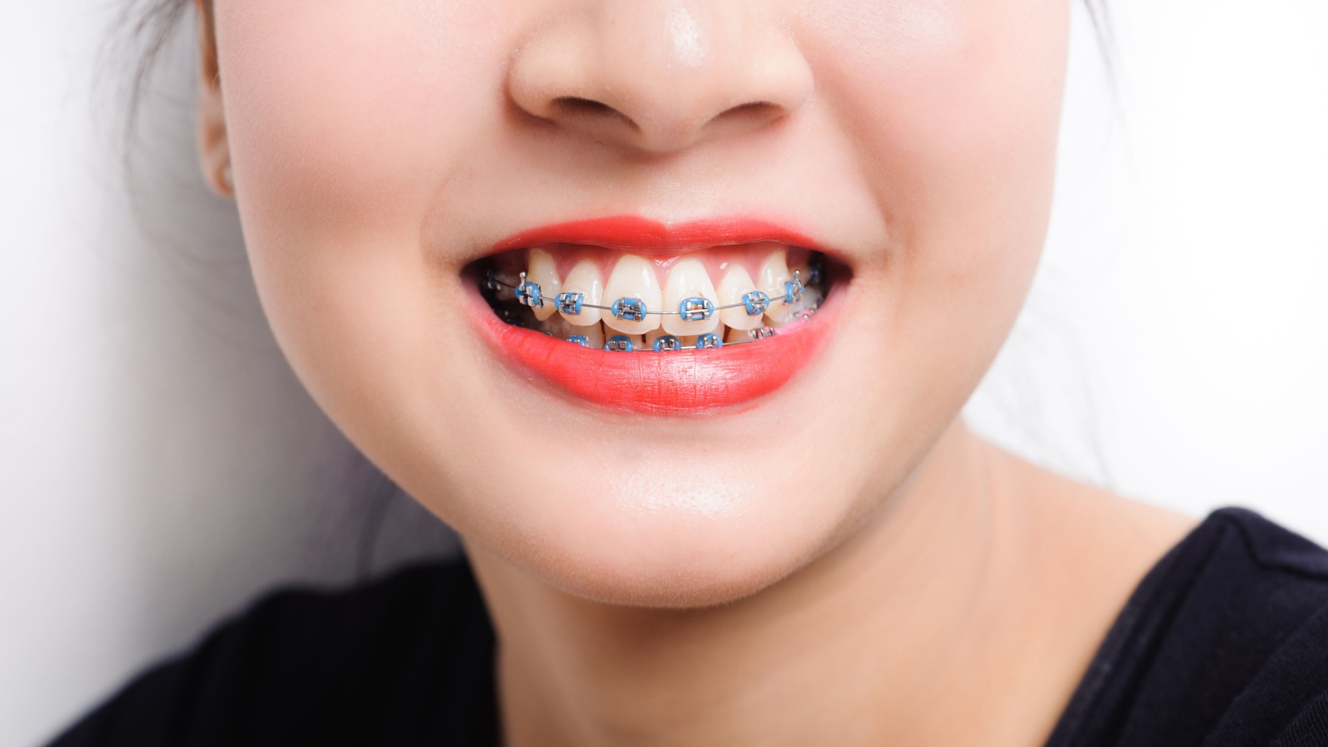 Propuesta Manhattan gris Cómo curar las llagas en tu boca si llevas ortodoncia